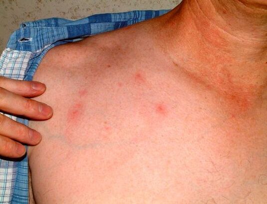 Symptômes de parasites sous la peau