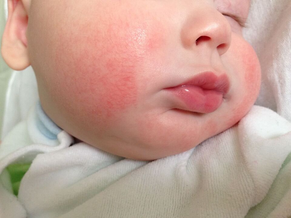 Un signe de vers chez un enfant est une urticaire allergique